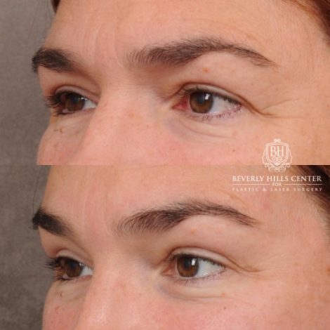 Beverly Hills Center Female Patient Before and After AuraLyft, Temporal Brow Reset, PHAT Face, TCA Lower Eyelids