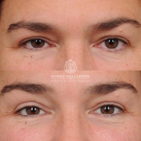 Beverly Hills Center Female Patient Before and After AuraLyft, Temporal Brow Reset, PHAT Face, TCA Lower Eyelids