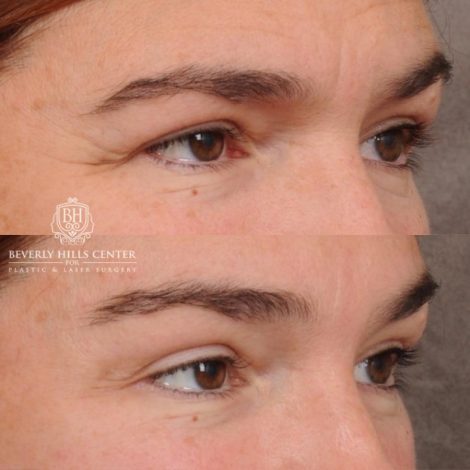 Beverly Hills Center Female Patient Before and After AuraLyft, Temporal Brow Reset, PHAT Face, TCA Lower Eyelids