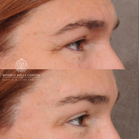 Beverly Hills Center Female Patient Before and After AuraLyft, Temporal Brow Reset, PHAT Face, TCA Lower Eyelids