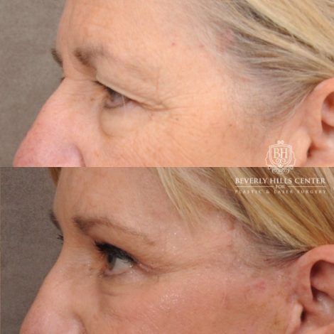 Beverly Hills Center Female Patient Before and After AuraLyft™, Temporal Brow Reset, Upper & Lower Blepharoplasty, Ptosis Repair