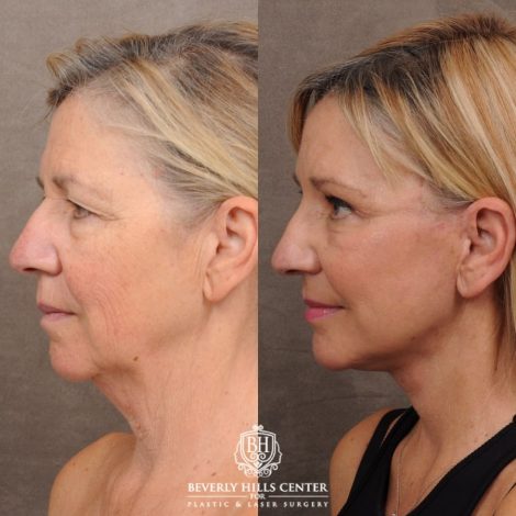 Beverly Hills Center Female Patient Before and After AuraLyft™, Temporal Brow Reset, Upper & Lower Blepharoplasty, Ptosis Repair