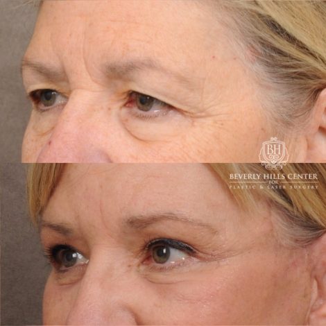 Beverly Hills Center Female Patient Before and After AuraLyft™, Temporal Brow Reset, Upper & Lower Blepharoplasty, Ptosis Repair