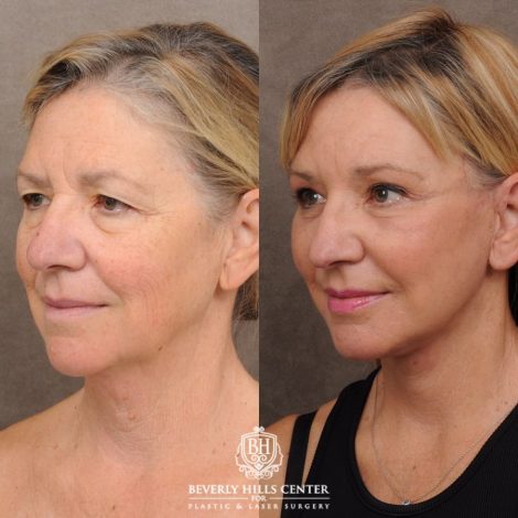 Beverly Hills Center Female Patient Before and After AuraLyft™, Temporal Brow Reset, Upper & Lower Blepharoplasty, Ptosis Repair