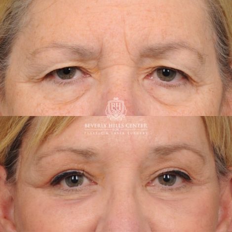 Beverly Hills Center Female Patient Before and After AuraLyft™, Temporal Brow Reset, Upper & Lower Blepharoplasty, Ptosis Repair