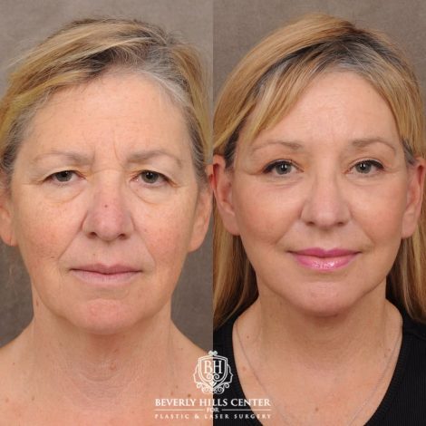 Beverly Hills Center Female Patient Before and After AuraLyft™, Temporal Brow Reset, Upper & Lower Blepharoplasty, Ptosis Repair