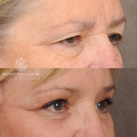 Beverly Hills Center Female Patient Before and After AuraLyft™, Temporal Brow Reset, Upper & Lower Blepharoplasty, Ptosis Repair