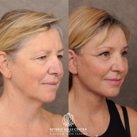 Beverly Hills Center Female Patient Before and After AuraLyft™, Temporal Brow Reset, Upper & Lower Blepharoplasty, Ptosis Repair