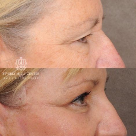 Beverly Hills Center Female Patient Before and After AuraLyft™, Temporal Brow Reset, Upper & Lower Blepharoplasty, Ptosis Repair