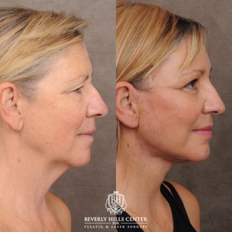 Beverly Hills Center Female Patient Before and After AuraLyft™, Temporal Brow Reset, Upper & Lower Blepharoplasty, Ptosis Repair