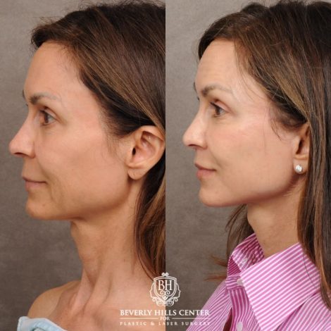 Beverly Hills Center Female Patient Before and After AuraLyft™, Cupid Lift, Upper Blepharoplasty, Minor Fat Grafting, and Nanofat