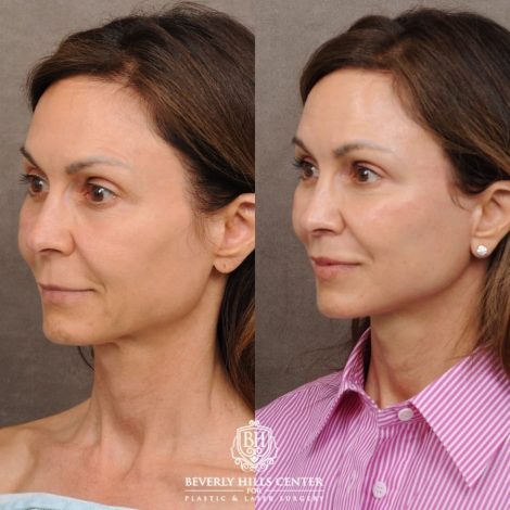 Beverly Hills Center Female Patient Before and After AuraLyft™, Cupid Lift, Upper Blepharoplasty, Minor Fat Grafting, and Nanofat
