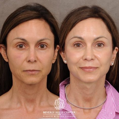 Beverly Hills Center Female Patient Before and After AuraLyft™, Cupid Lift, Upper Blepharoplasty, Minor Fat Grafting, and Nanofat