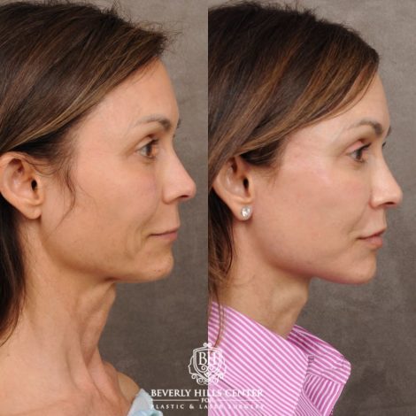 Beverly Hills Center Female Patient Before and After AuraLyft™, Cupid Lift, Upper Blepharoplasty, Minor Fat Grafting, and Nanofat