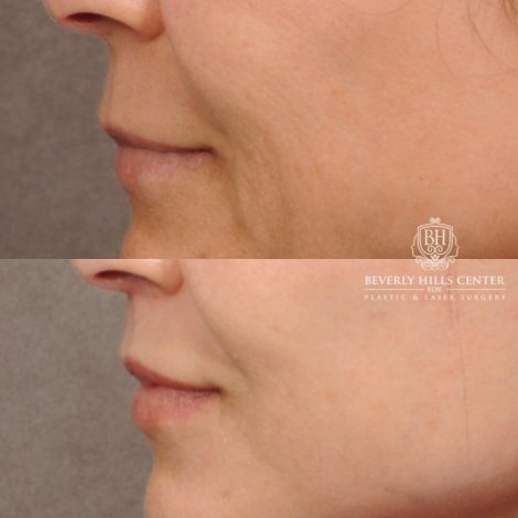 Beverly Hills Center Female Patient Before and After AuraLyft™, Cupid Lift, Upper Blepharoplasty, Minor Fat Grafting, and Nanofat