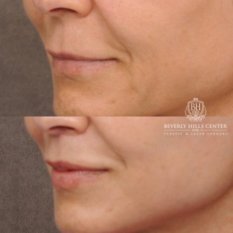Beverly Hills Center Female Patient Before and After AuraLyft™, Cupid Lift, Upper Blepharoplasty, Minor Fat Grafting, and Nanofat