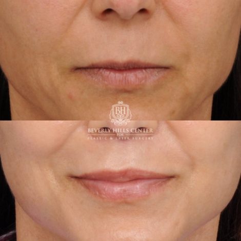 Beverly Hills Center Female Patient Before and After AuraLyft™, Cupid Lift, Upper Blepharoplasty, Minor Fat Grafting, and Nanofat