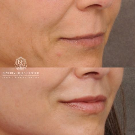 Beverly Hills Center Female Patient Before and After AuraLyft™, Cupid Lift, Upper Blepharoplasty, Minor Fat Grafting, and Nanofat