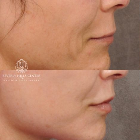 Beverly Hills Center Female Patient Before and After AuraLyft™, Cupid Lift, Upper Blepharoplasty, Minor Fat Grafting, and Nanofat