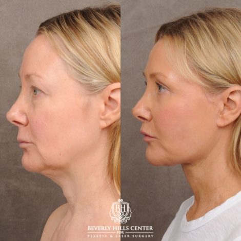 Beverly Hills Center Female Patient Before and After AuraLyft, Cupid Lift®, Upper Blepharoplasty, Fat Grafting, Chin Implant, TCA Peel on Lower Eyelids