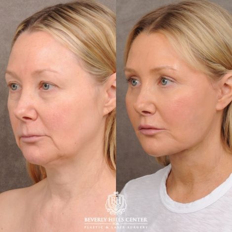 Beverly Hills Center Female Patient Before and After AuraLyft, Cupid Lift®, Upper Blepharoplasty, Fat Grafting, Chin Implant, TCA Peel on Lower Eyelids