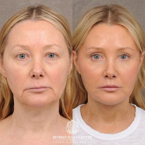 Beverly Hills Center Female Patient Before and After AuraLyft, Cupid Lift®, Upper Blepharoplasty, Fat Grafting, Chin Implant, TCA Peel on Lower Eyelids