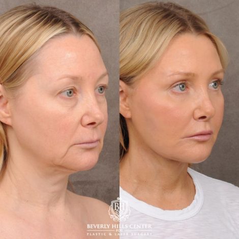 Beverly Hills Center Female Patient Before and After AuraLyft, Cupid Lift®, Upper Blepharoplasty, Fat Grafting, Chin Implant, TCA Peel on Lower Eyelids