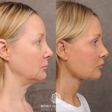 Beverly Hills Center Female Patient Before and After AuraLyft, Cupid Lift®, Upper Blepharoplasty, Fat Grafting, Chin Implant, TCA Peel on Lower Eyelids