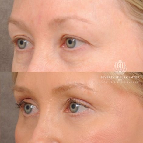 Beverly Hills Center Female Patient Before and After AuraLyft, Cupid Lift®, Upper Blepharoplasty, Fat Grafting, Chin Implant, TCA Peel on Lower Eyelids