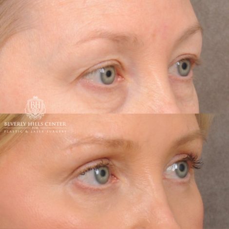 Beverly Hills Center Female Patient Before and After AuraLyft, Cupid Lift®, Upper Blepharoplasty, Fat Grafting, Chin Implant, TCA Peel on Lower Eyelids