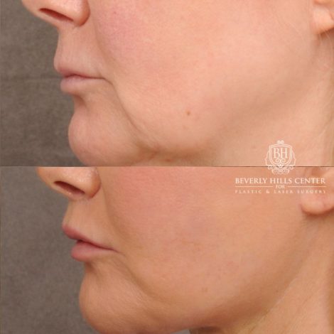 Beverly Hills Center Female Patient Before and After AuraLyft, Cupid Lift®, Upper Blepharoplasty, Fat Grafting, Chin Implant, TCA Peel on Lower Eyelids