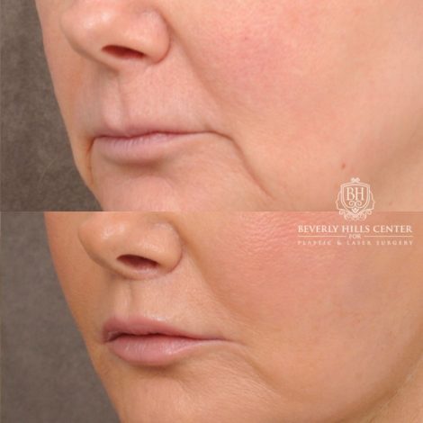 Beverly Hills Center Female Patient Before and After AuraLyft, Cupid Lift®, Upper Blepharoplasty, Fat Grafting, Chin Implant, TCA Peel on Lower Eyelids