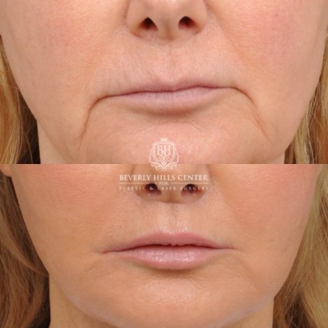 Beverly Hills Center Female Patient Before and After AuraLyft, Cupid Lift®, Upper Blepharoplasty, Fat Grafting, Chin Implant, TCA Peel on Lower Eyelids