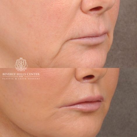 Beverly Hills Center Female Patient Before and After AuraLyft, Cupid Lift®, Upper Blepharoplasty, Fat Grafting, Chin Implant, TCA Peel on Lower Eyelids