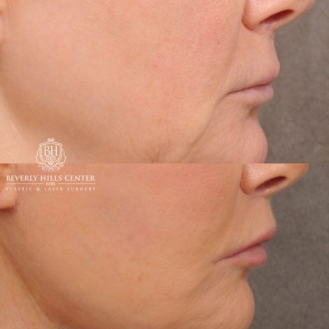 Beverly Hills Center Female Patient Before and After AuraLyft, Cupid Lift®, Upper Blepharoplasty, Fat Grafting, Chin Implant, TCA Peel on Lower Eyelids