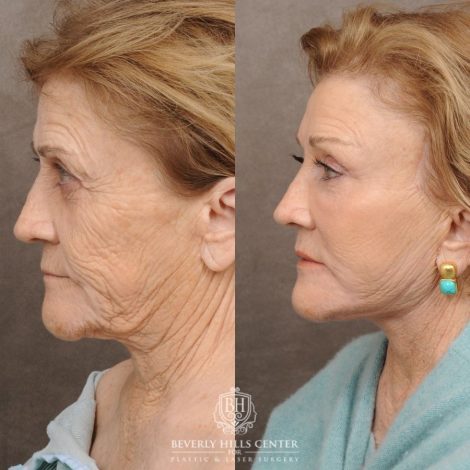 Beverly Hills Center Female Patient Before and After AuraLyft™, Fat Grafting, Ptosis Repair