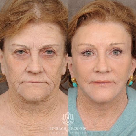 Beverly Hills Center Female Patient Before and After AuraLyft™, Fat Grafting, Ptosis Repair