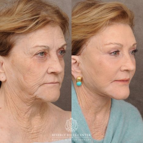 Beverly Hills Center Female Patient Before and After AuraLyft™, Fat Grafting, Ptosis Repair