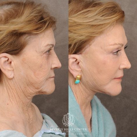 Beverly Hills Center Female Patient Before and After AuraLyft™, Fat Grafting, Ptosis Repair