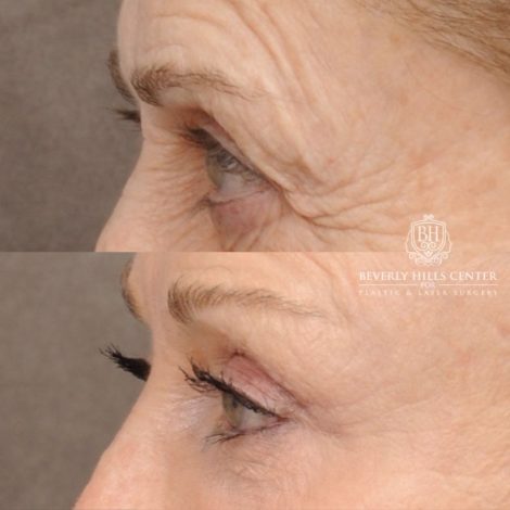 Beverly Hills Center Female Patient Before and After AuraLyft™, Fat Grafting, Ptosis Repair