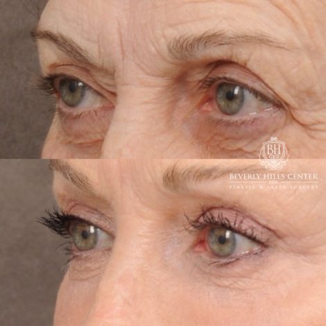 Beverly Hills Center Female Patient Before and After AuraLyft™, Fat Grafting, Ptosis Repair