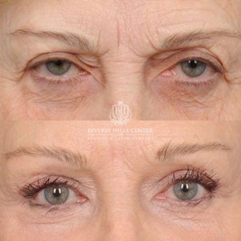 Beverly Hills Center Female Patient Before and After AuraLyft™, Fat Grafting, Ptosis Repair