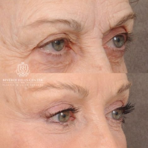 Beverly Hills Center Female Patient Before and After AuraLyft™, Fat Grafting, Ptosis Repair