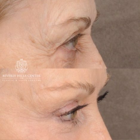 Beverly Hills Center Female Patient Before and After AuraLyft™, Fat Grafting, Ptosis Repair