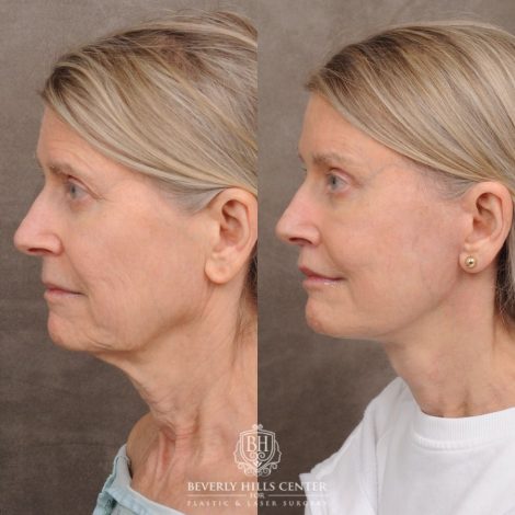 Beverly Hills Center Female Patient Before and After AuraLyft™, Cupid Lift®, Temporal Brow Reset, Upper Blepharoplasty, Fat Grafting, Ptosis Repair
