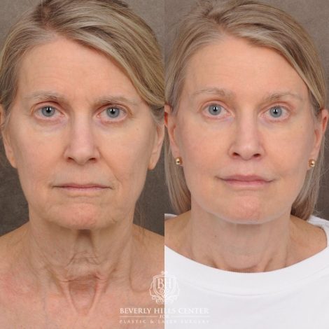 Beverly Hills Center Female Patient Before and After AuraLyft™, Cupid Lift®, Temporal Brow Reset, Upper Blepharoplasty, Fat Grafting, Ptosis Repair