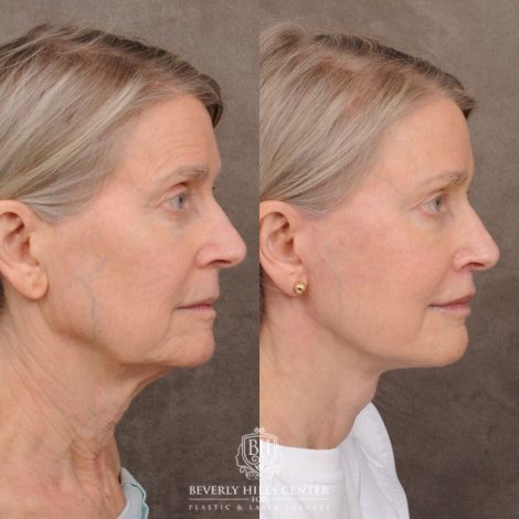 Beverly Hills Center Female Patient Before and After AuraLyft™, Cupid Lift®, Temporal Brow Reset, Upper Blepharoplasty, Fat Grafting, Ptosis Repair