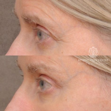 Beverly Hills Center Female Patient Before and After AuraLyft™, Cupid Lift®, Temporal Brow Reset, Upper Blepharoplasty, Fat Grafting, Ptosis Repair