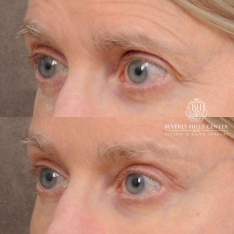 Beverly Hills Center Female Patient Before and After AuraLyft™, Cupid Lift®, Temporal Brow Reset, Upper Blepharoplasty, Fat Grafting, Ptosis Repair