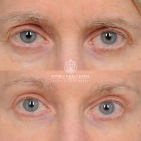 Beverly Hills Center Female Patient Before and After AuraLyft™, Cupid Lift®, Temporal Brow Reset, Upper Blepharoplasty, Fat Grafting, Ptosis Repair